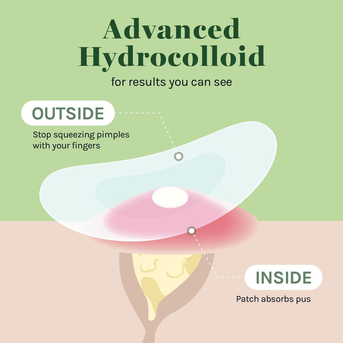 AOA Studio 84-count Hydrocolloid Acne Patches, Vegan, Cruelty-Free, 10mm, 12mm Sizes, Spot Treatment for Blemishes and Acne